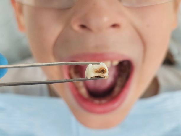 Best Emergency Dental Care for Sports Injuries in Country Walk, FL